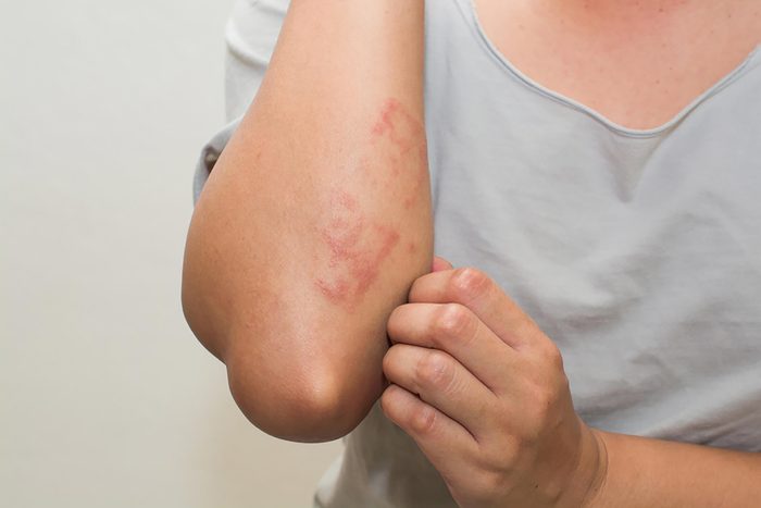 rash on arm