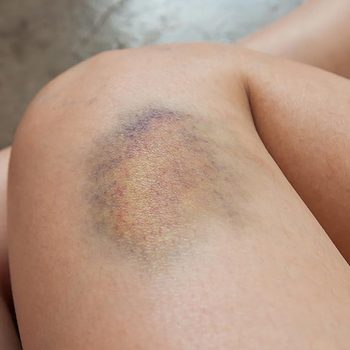 bruise