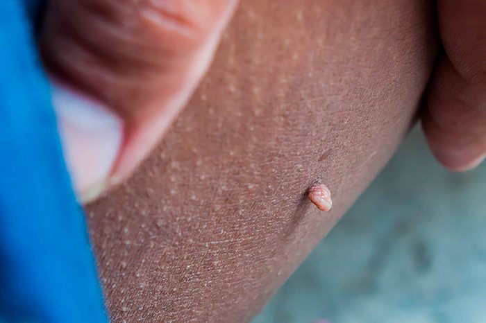 Skin tag on a person's skin.
