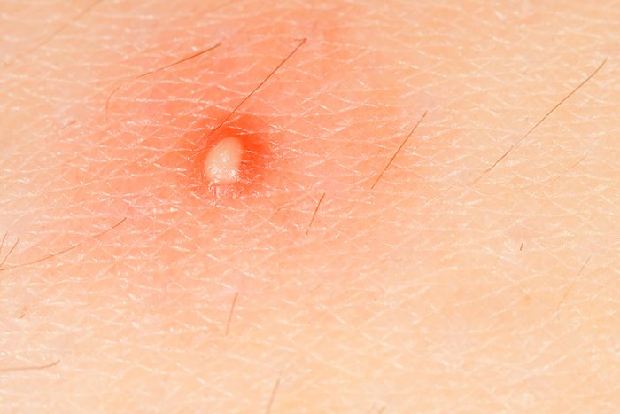 close up of a boil