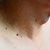 9 Myths About Skin Tags You Need to Stop Believing
