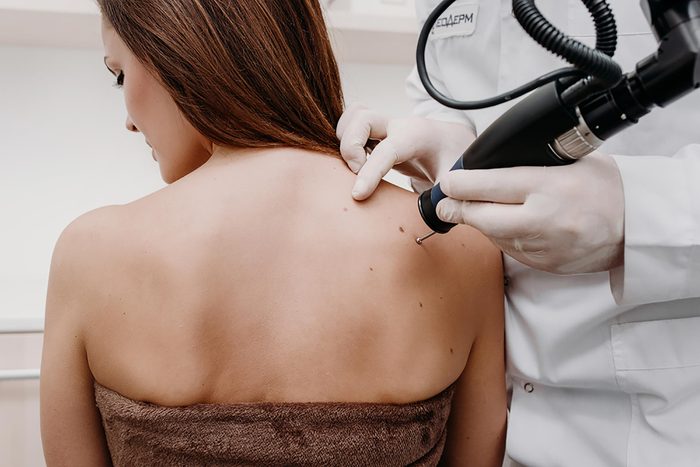 Woman getting skin tags removed on her back with a machine.
