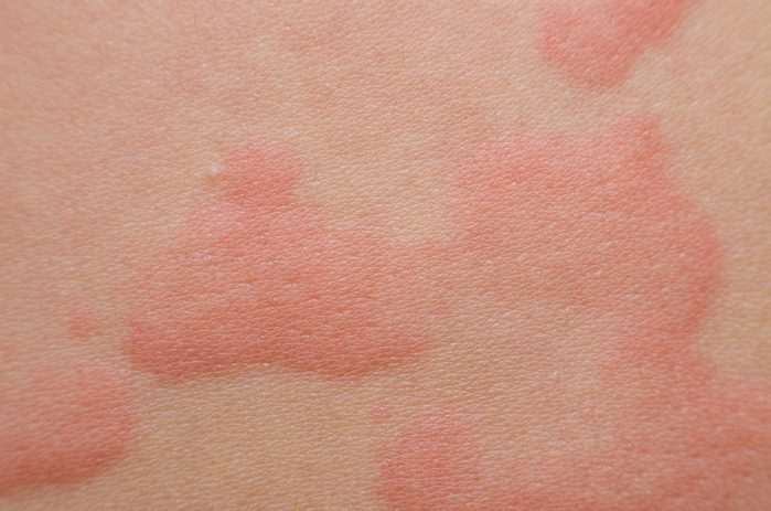 Close up Allergy rash, Around Back view of human with dermatitis problem of rash ,Allergy rash and Health problem.