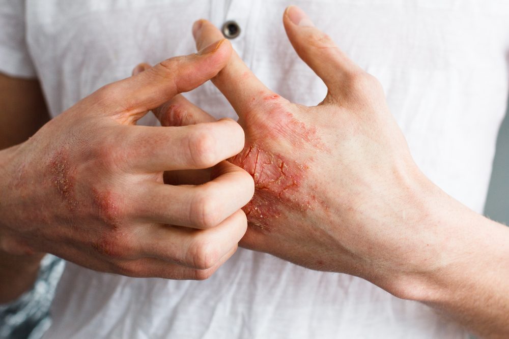 eczema on hand.