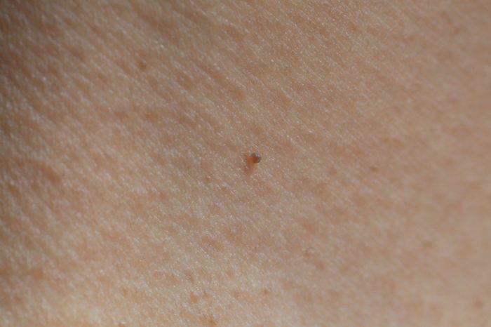 Raised seborrheic keratosis on a person's neck.